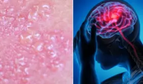 Vacuna contra el herpes zóster podría reducir el riesgo de demencia en un 20%, según estudio