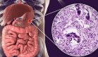 Nueva terapia podría reducir los tumores en cáncer gastrointestinal metastásico: Estudio
