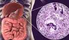 Nueva terapia podría reducir los tumores en cáncer gastrointestinal metastásico: Estudio
