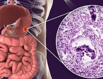 Nueva terapia podría reducir los tumores en cáncer gastrointestinal metastásico: Estudio