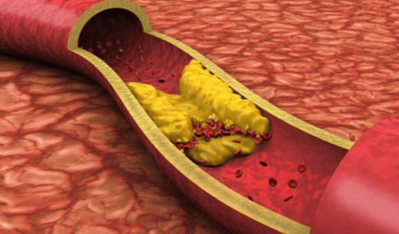 El nivel de calcio en las arterias podría ser un indicador de longevidad y bajo riesgo cardíaco