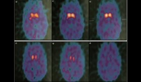 Complicación infecciosa tras estimulación cerebral profunda en tratamiento en joven con Parkinson juvenil