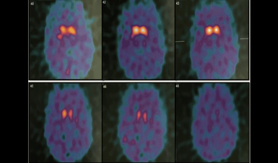 Complicación infecciosa tras estimulación cerebral profunda en tratamiento en joven con Parkinson juvenil