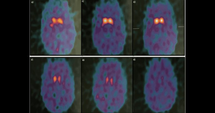 Complicación infecciosa tras estimulación cerebral profunda en tratamiento en joven con Parkinson juvenil
