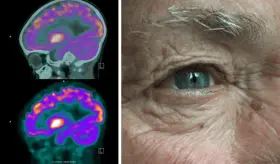 ¿Por qué algunos pacientes con alzhéimer pierden la vista antes que la memoria?