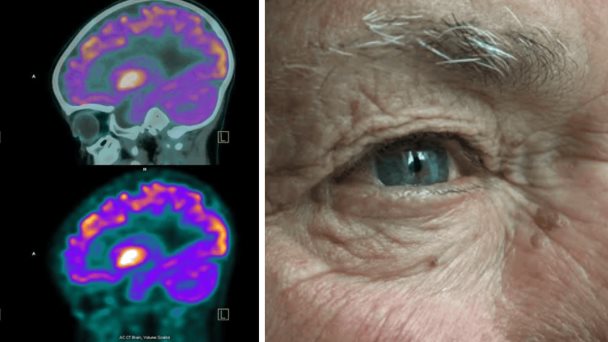 ¿Por qué algunos pacientes con alzhéimer pierden la vista antes que la memoria?