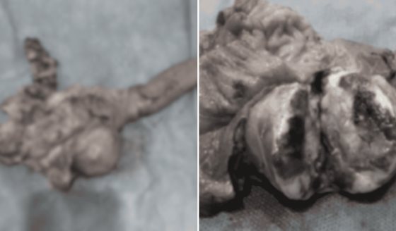 Diagnostican gastrinoma pancreático en paciente con úlcera péptica que ocasionaba hematemesis y melena
