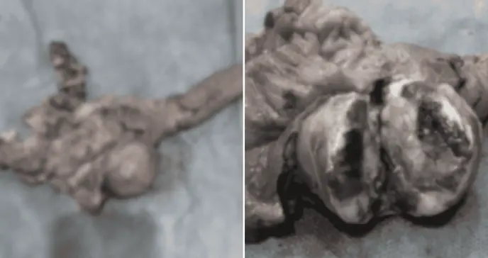 Diagnostican gastrinoma pancreático en paciente con úlcera péptica que ocasionaba hematemesis y melena