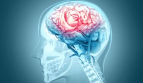 Hospitalizaciones por ACV causados por desgarros arteriales se quintuplicaron en EE. UU. en 15 años