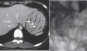 Hipoalbuminemia y edema como manifestaciones iniciales de enfermedad de Ménétrier en una joven de 16 años