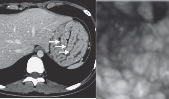 Hipoalbuminemia y edema como manifestaciones iniciales de enfermedad de Ménétrier en una joven de 16 años