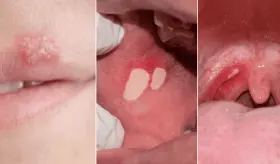 7 enfermedades que puedes contraer por practicar sexo oral y cómo prevenirlas