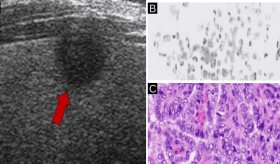 Paciente con antecedentes de cáncer de tiroides desarrolla una segunda neoplasia tiroidea diferente