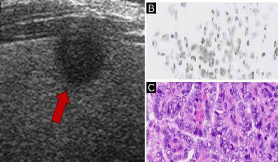 Paciente con antecedentes de cáncer de tiroides desarrolla una segunda neoplasia tiroidea diferente