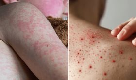 Alerta sanitaria por brote de sarampión en EE.UU.  con más de 600 Infectados y 2 fallecidos