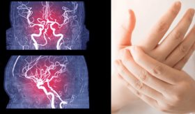 Episodio migrañoso en menor de 10 años se presenta con pérdida de sensibilidad en extremidades y cefalea