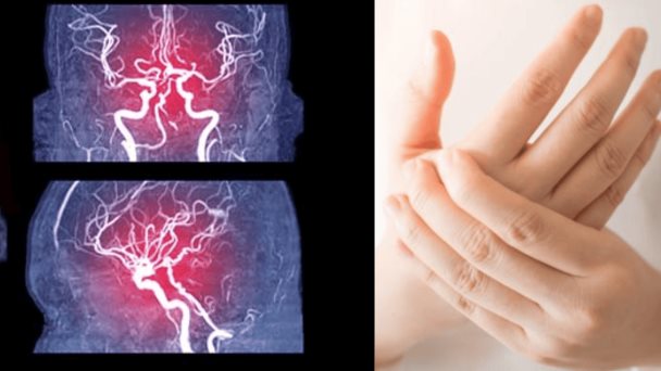 Episodio migrañoso en menor de 10 años se presenta con pérdida de sensibilidad en extremidades y cefalea Episodio migrañoso en menor de 10 años se presenta con pérdida de sensibilidad en extremidades y cefalea