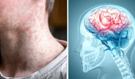 1 de cada 1,000 niños con sarampión puede desarrollar encefalitis, provocando daño cerebral irreversible