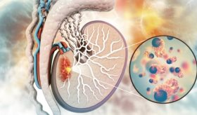 Cambios en el escroto, bulto pequeño e indoloro y otros síntomas que podrían indicar cáncer testicular