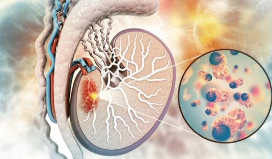 Cambios en el escroto, bulto pequeño e indoloro y otros síntomas que podrían indicar cáncer testicular