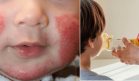 Desarrollan terapia que reduce la inflamación de la dermatitis atópica infantil y frena el asma
