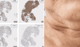 Hombre de 54 años con ganglios inflamados es diagnosticado con dos tipos de linfoma a la vez  