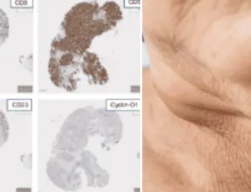 Hombre de 54 años con ganglios inflamados es diagnosticado con dos tipos de linfoma a la vez  