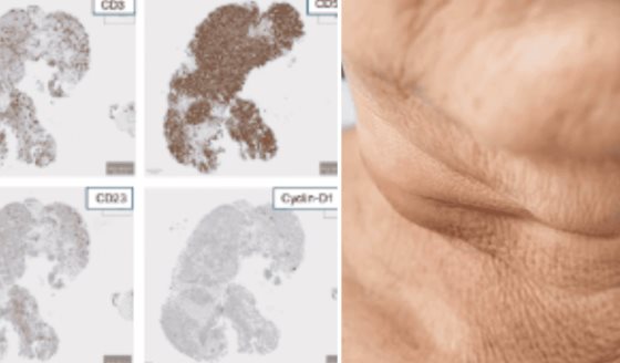 Hombre de 54 años con ganglios inflamados es diagnosticado con dos tipos de linfoma a la vez  
