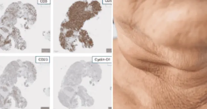 Hombre de 54 años con ganglios inflamados es diagnosticado con dos tipos de linfoma a la vez  
