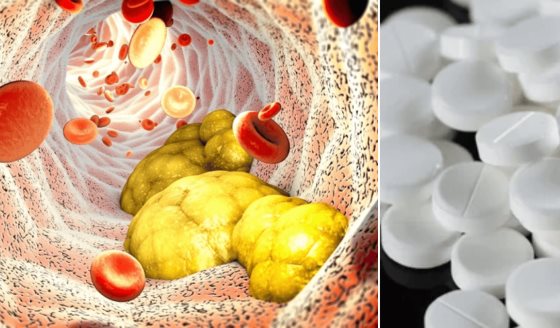 Terapia combinada con estatinas y ezetimiba reduce 30% riesgo post-infarto, según estudio 
