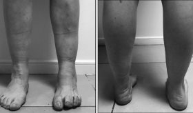 Paciente presenta síndrome de la persona rígida diagnosticado tras años de síntomas no reconocidos