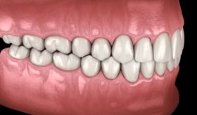 Crean dientes humanos en laboratorio con células del propio paciente: Más fuertes y sin riesgo de rechazo