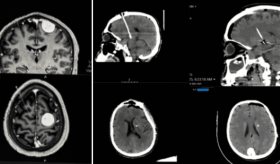 Tratamiento quirúrgico del párkinson con tumores cerebrales: Dos casos exitosos