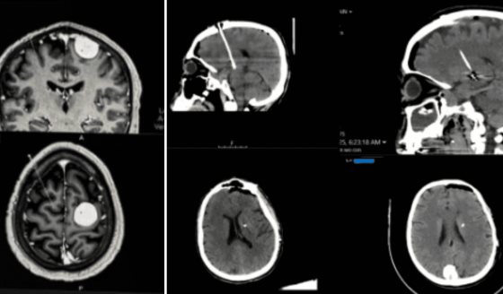 Tratamiento quirúrgico del párkinson con tumores cerebrales: Dos casos exitosos