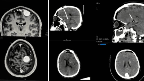 Tratamiento quirúrgico del párkinson con tumores cerebrales: Dos casos exitosos Tratamiento quirúrgico del párkinson con tumores cerebrales: Dos casos exitosos