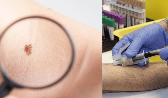 Desarrollan análisis de sangre que predice con alta precisión la recurrencia del melanoma en estadio III