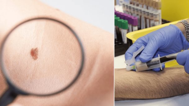 Desarrollan análisis de sangre que predice con alta precisión la recurrencia del melanoma en estadio III