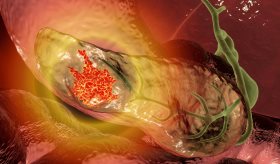 Galectina-1 en fibroblastos regula genes clave y promueve la agresividad del cáncer de páncreas: Estudio