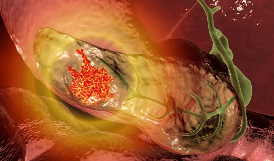 Galectina-1 en fibroblastos regula genes clave y promueve la agresividad del cáncer de páncreas: Estudio