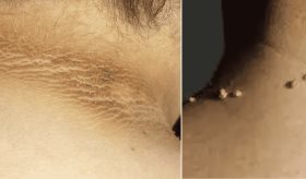 Verrugas y manchas oscuras en el cuello: Las señales que anticipan el diagnóstico de diabetes tipo 2