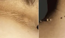 Verrugas y manchas oscuras en el cuello: Las señales que anticipan el diagnóstico de diabetes tipo 2