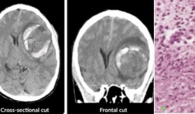 Paciente con neurofibromatosis desarrolla gliosarcoma: Manchas y desorientación como presentación inicial