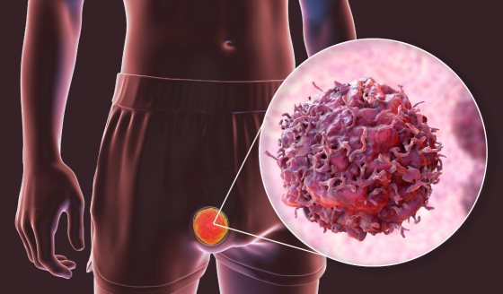 Jóvenes entre 15 y 35 años, los más vulnerables al cáncer testicular en Puerto Rico