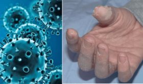 Detectan indicios de un virus respiratorio como posible causa de la enfermedad de Kawasaki en niños