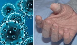 Detectan indicios de un virus respiratorio como posible causa de la enfermedad de Kawasaki en niños