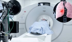 Proponen un cribado universal de cáncer de pulmón para reducir mortalidad y mejorar el diagnóstico precoz