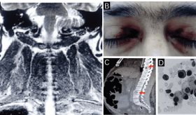 Amiloidosis AL con compromiso neuromuscular y cardíaco como presentación de mieloma múltiple oculto