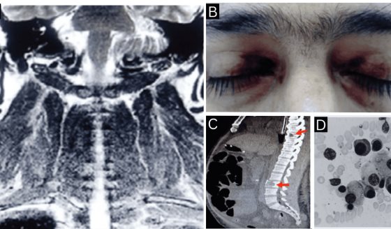 Amiloidosis AL con compromiso neuromuscular y cardíaco como presentación de mieloma múltiple oculto