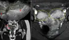 Dolor pélvico agudo y sangrado en adolescente: Resonancia revela útero doble y agenesia renal ipsilateral