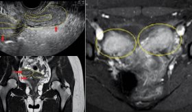 Dolor pélvico agudo y sangrado en adolescente: Resonancia revela útero doble y agenesia renal ipsilateral